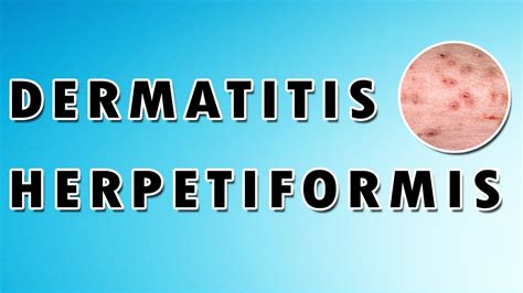 Dermatitis Herpetiformis Treatment Causes And Symptoms Dermatology Course YouTube
