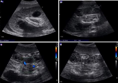 Ultrasonographic Appearance Of The Acardiac Twin At 27 Weeks Of