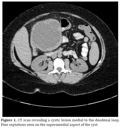 Colonic Duplication Cyst Mimicking As A Cystic Pancreatic Tumour Case