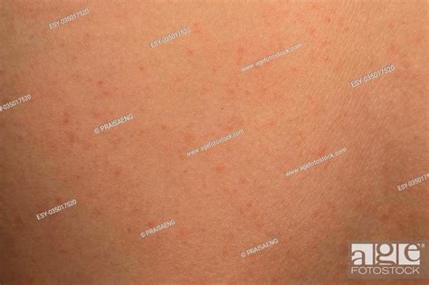 Allergic Rash Dermatitis Skin Texture Of Patient Stock Photo Picture