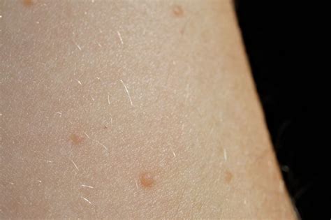 Cluster Of Blister Like Bumps At Skin Cancer Forum With Image Embedded