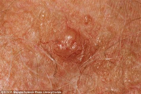 Revealed How To Tell If You Have Skin Cancer From Bleeding Itchy Moles To Flat Red Spots