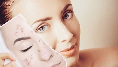 10 Common Acne Skincare Mistakes That Make It Worse Sensitive Skincare