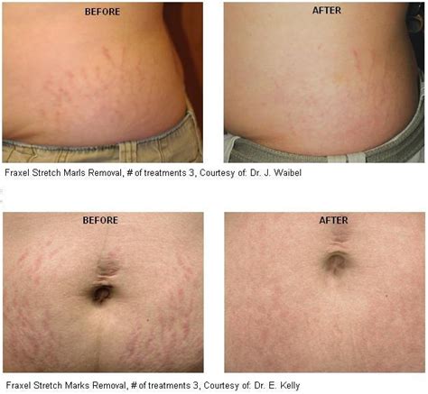 Top Pictures Laser Treatments For Stretch Marks Before And After