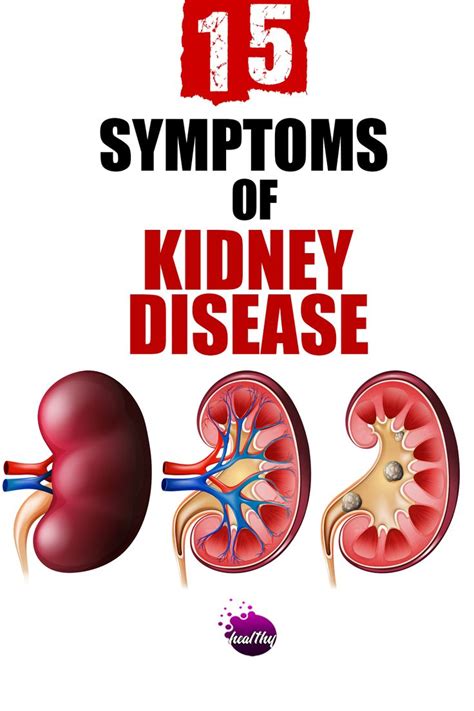 Early Signs Of Kidney Disease Kidney Disease Symptoms Kidney