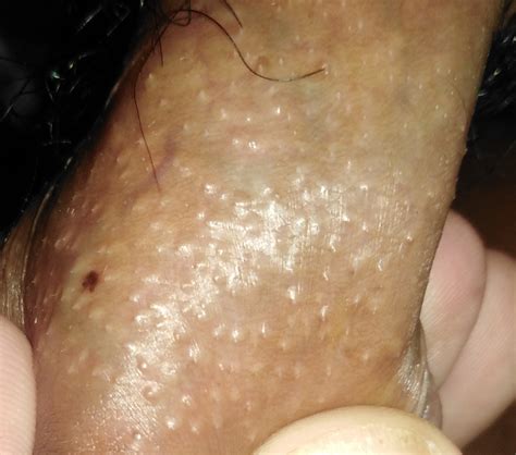 Help Ii This Fordyce Spots Or Something Else Penis Disorders Forums