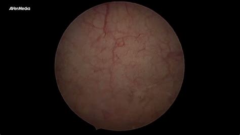 Diagnostic Cystoscopy For Recurrent Uti Youtube
