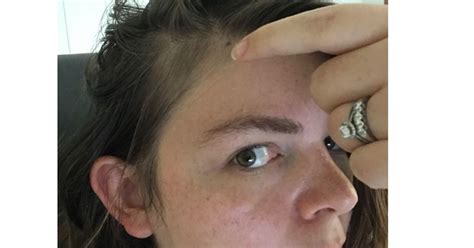 Tight hairstyles may also cause hair loss. Guys, What Is This Postpartum Hair Loss At The Temples ...