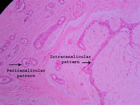 Fibroadenoma Histopathologyguru