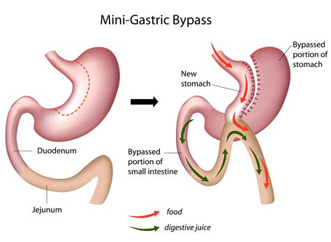 Mini Gastric Bypass Surgery Best Gastro Surgeon Ahmedabad Best