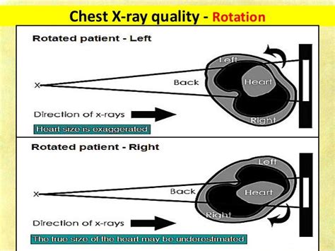 Chest X Ray Fundamentals