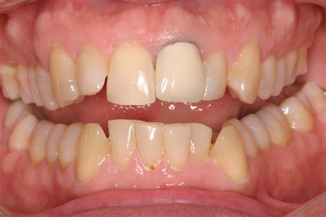 Reasons For Tooth Discoloration News Dentagama