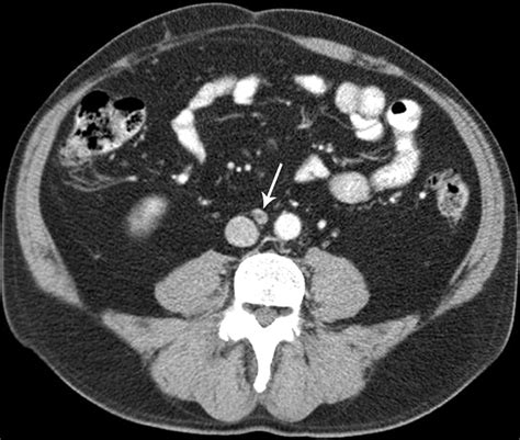 Current Concepts In Lymph Node Imaging