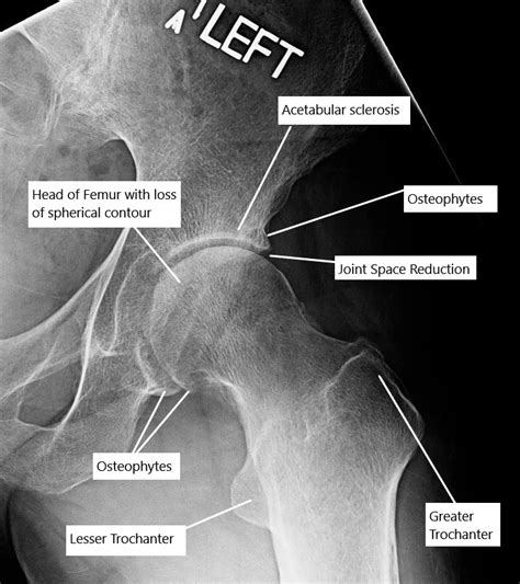 Osteoarthritis Complete Orthopedics Multiple Ny Locations