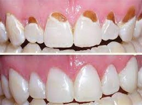 Tooth Decay At Gum Line With Pictures 2023 Go Fix Teeth