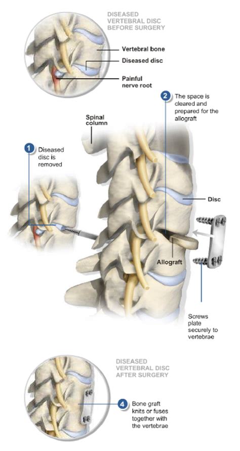 Anterior Cervical Discectomy And Fusion Acdf Dr Paul Jeffords Md