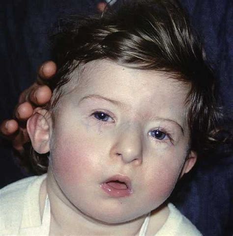 Prader Willi Syndrome Symptoms Cause Pictures Treatment