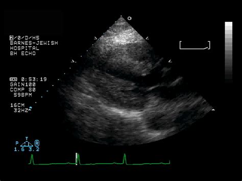 Sequentially activating a series of adjacent crystals to. MIR Teaching file case mi033
