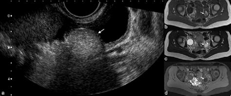 Figure 2 From Ultrasound In The Diagnosis Of Ovarian Dermoid Cysts A
