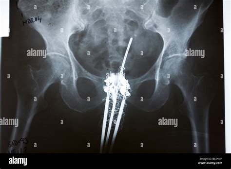 Pelvis X Ray Of Cervical Cancer Treatment With A Tandem And Ovoid Stock