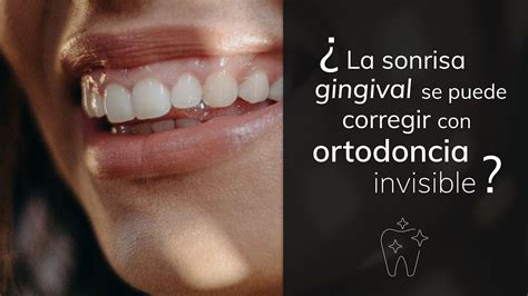 La Sonrisa Gingival Se Corrige Con Ortodoncia Invisible Youtube