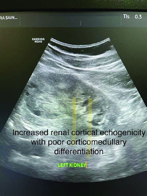 Increased Renal Cortical Echogenicity With Poor Corticomedullary Download Scientific Diagram