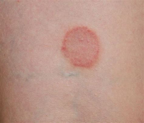 Red Circles Rash Pictures Photos