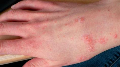Everything You Need To Know About Scabies Scabies Scabies Rash Images And Photos Finder