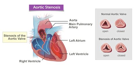 Aortic Valve Stenosis Boston Childrens Hospital