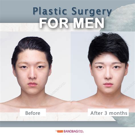 Mens Plastic Surgery Before And After Tymsleslie