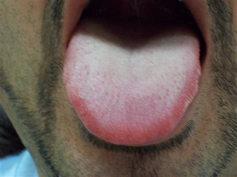 Normal Throat Looks Like Close Up Of Lymphoid Tissue On The Throat Of