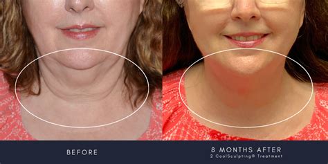 Coolsculpting For Double Chin Does It Really Work