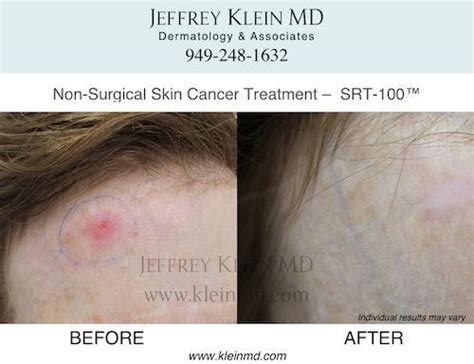 Srt 100 Non Surgical Skin Cancer Treatment Before And After Photos San