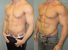 Professional Bodybuilders Gynecomastia Surgery - Before and After ...