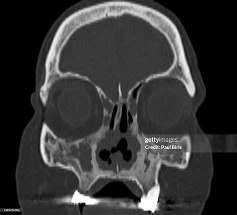 Saddle Nose Deformity Sinonasal Computed Tomography In Patients With