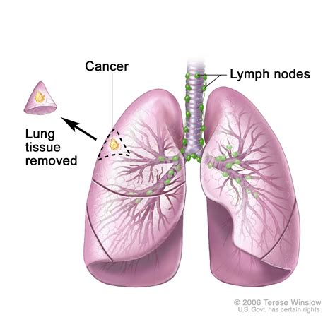 Lung cancer may spread (metastasize) to the brain. Pin on HUMAN ANATOMY