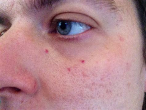 Red Spots On Face Babycenter