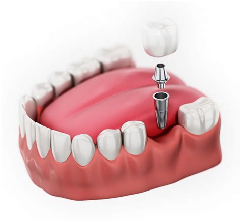 Single Tooth Dental Implant Process Arizona Periodontal Group
