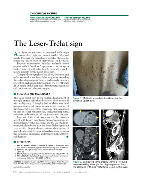 The Leser Trélat Sign Cleveland Clinic Journal Of Medicine