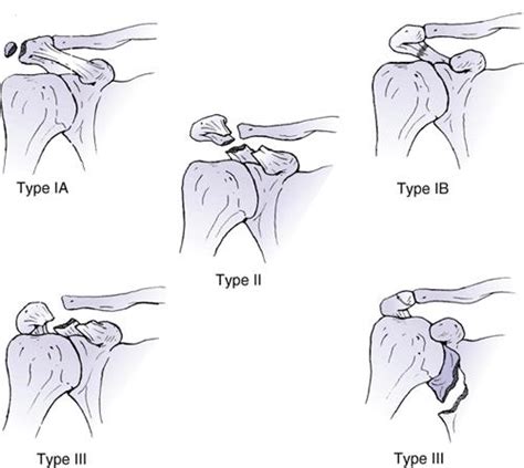 Scapula Fracture Orthobullets