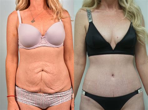 Tummy Tuck Before And After And The Average Cost Fitoont
