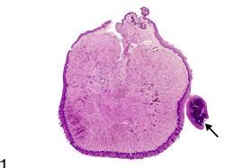 Tongue Mucosa Fibroepithelial Polyp Nonneoplastic Lesion Atlas