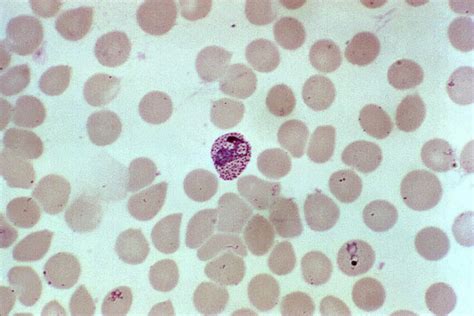 Free Picture Red Blood Cell Infection Plasmodium Vivax Mature