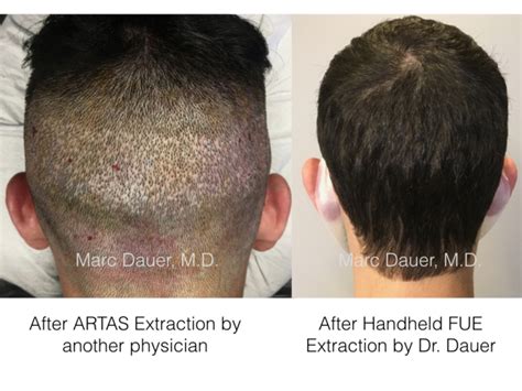 Hair Restoration Blog Hair Transplant Surgeon Los Angeles Marc Dauer Md