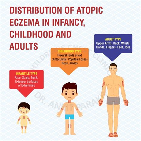 Atopic Dermatitis Eczema Dr Ankit Parakh