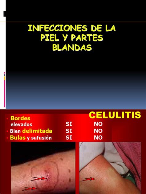 Infecciones De La Piel Y Partes Blandasppt