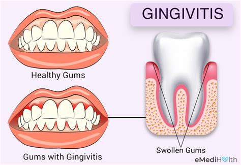 Gingivitis 101 Types Causes Treatment And Risk Factors