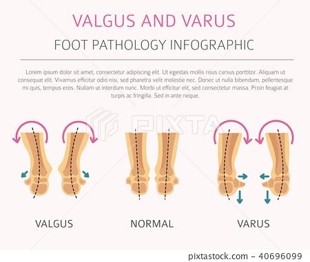 Foot Varus And Valgus Medical Infographic Stock Illustration Pixta
