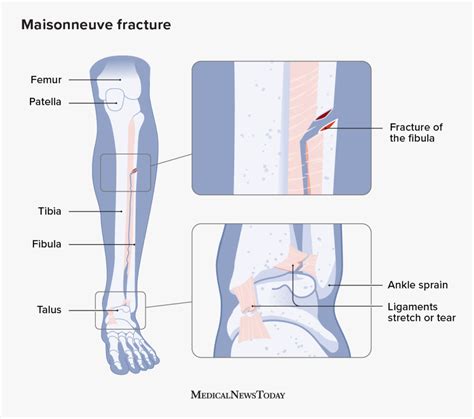 Maisonneuve Fracture Anatomy Treatment And Recovery