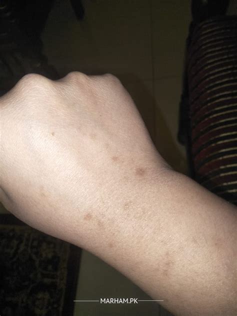 Ask A Dermatologist Online For Dark Spots On Hands